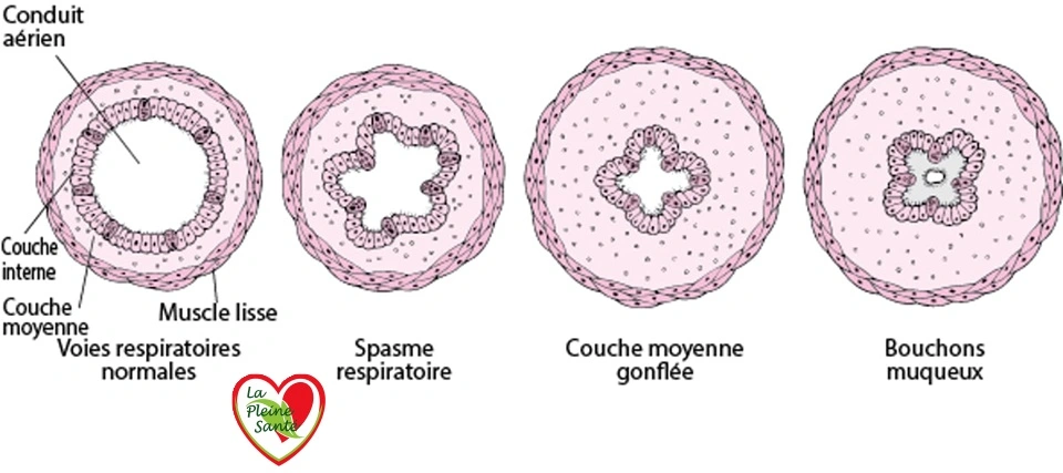 Le nerf vague est directement impliqué dans deux des mécanismes centraux de l'asthme : la bronchoconstriction et l'inflammation des voies respiratoires.